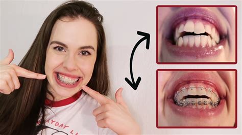 My ONE MONTH Braces Update & Transformation .